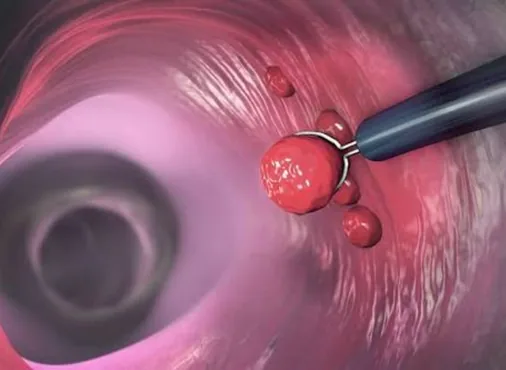 Colonic Polyps consultation at Niraaya Hospital